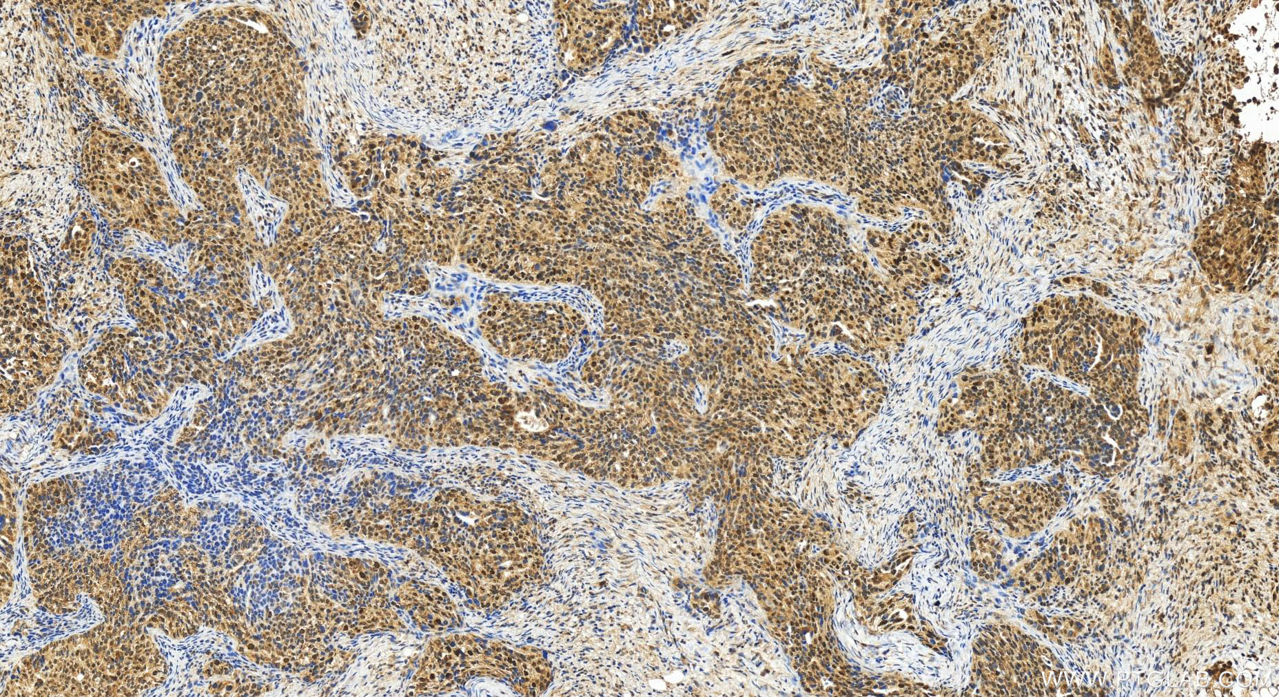 IHC staining of human ovary cancer using 20992-1-AP