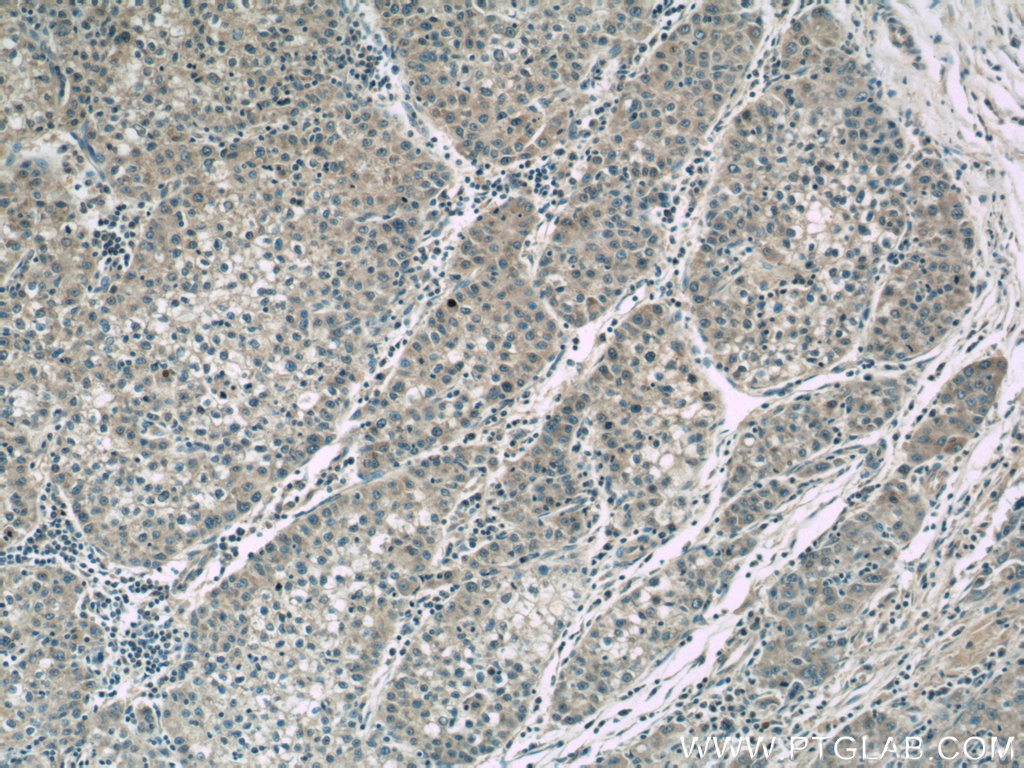 IHC staining of human liver cancer using 60264-1-Ig (same clone as 60264-1-PBS)