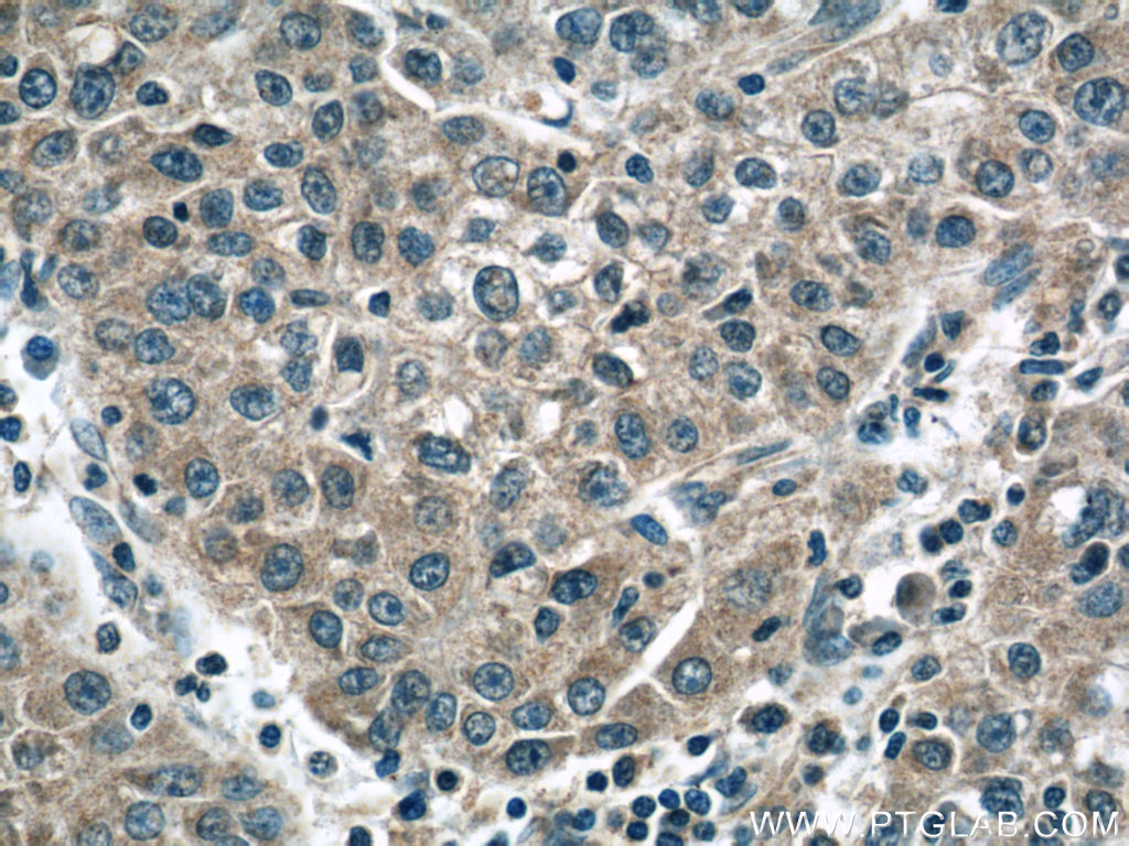 IHC staining of human liver cancer using 60264-1-Ig