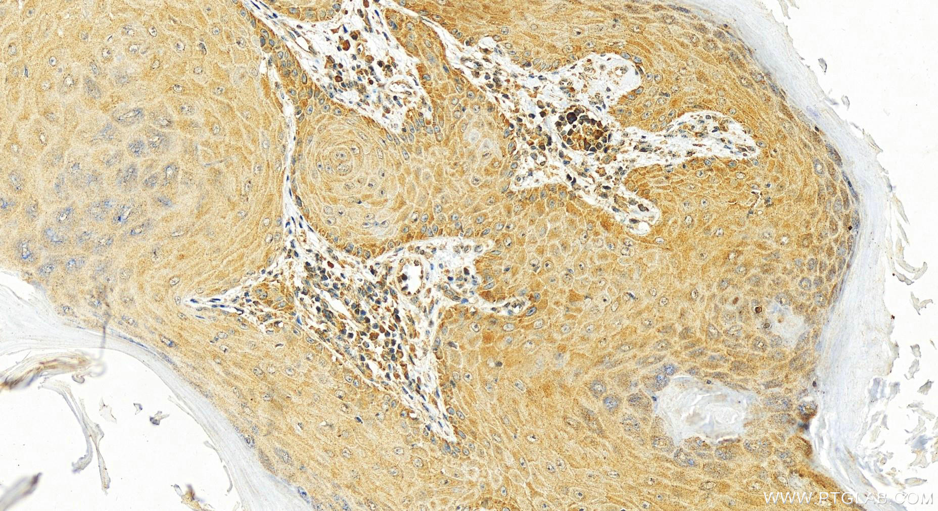 IHC staining of human skin cancer using 67400-1-Ig