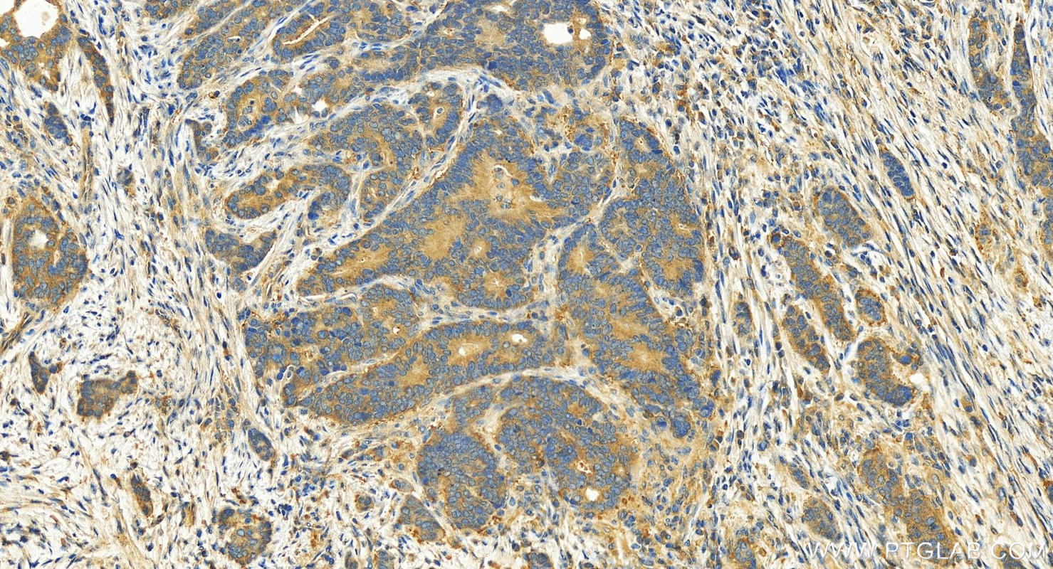 IHC staining of human stomach cancer using 19793-1-AP