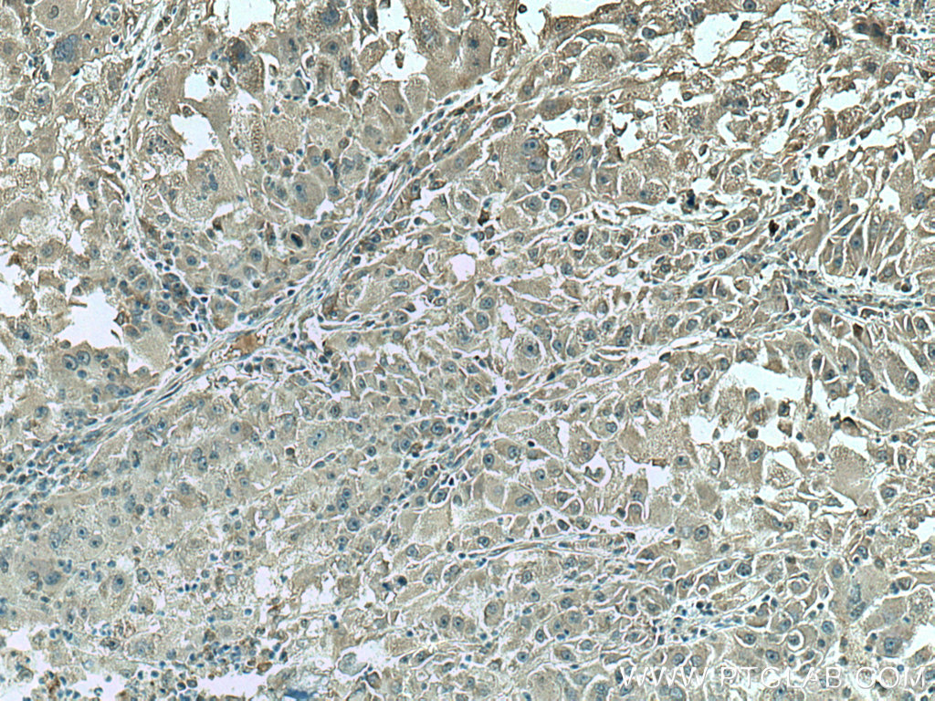 IHC staining of human liver cancer using 67539-1-Ig (same clone as 67539-1-PBS)