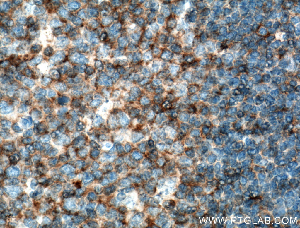 IHC staining of human tonsillitis using 66582-1-Ig (same clone as 66582-1-PBS)