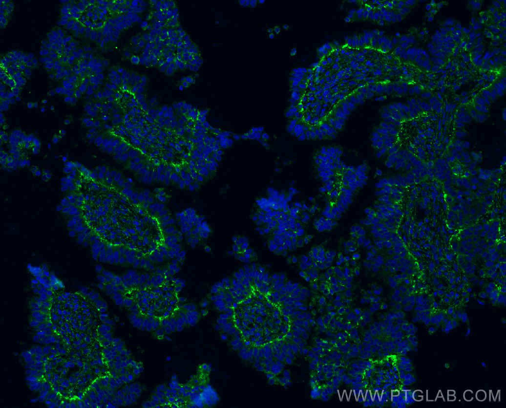 IF Staining of human ovary tumor using 21997-1-AP