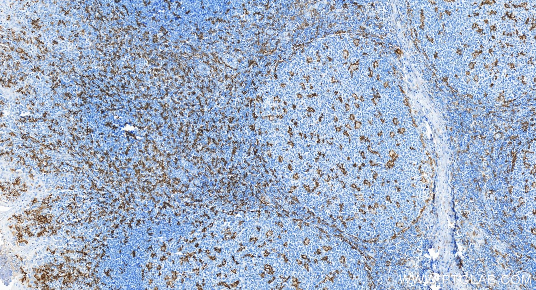 IHC staining of human tonsillitis using 81853-1-RR (same clone as 81853-1-PBS)