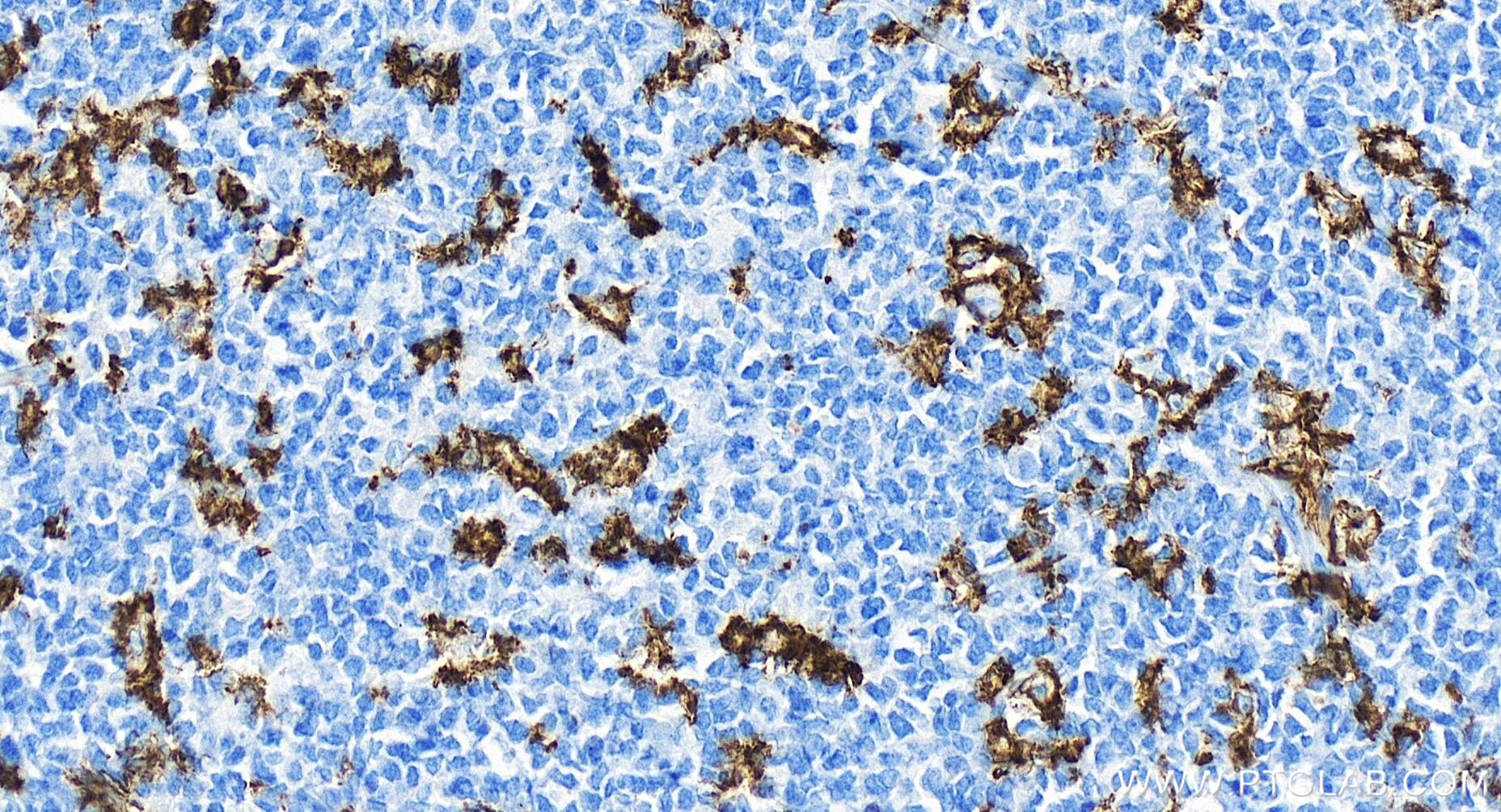 IHC staining of human tonsillitis using 81853-1-RR (same clone as 81853-1-PBS)