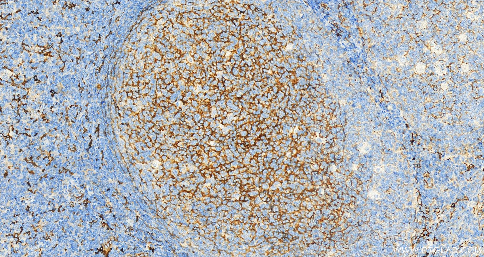 IHC staining of human tonsillitis using 17000-1-AP