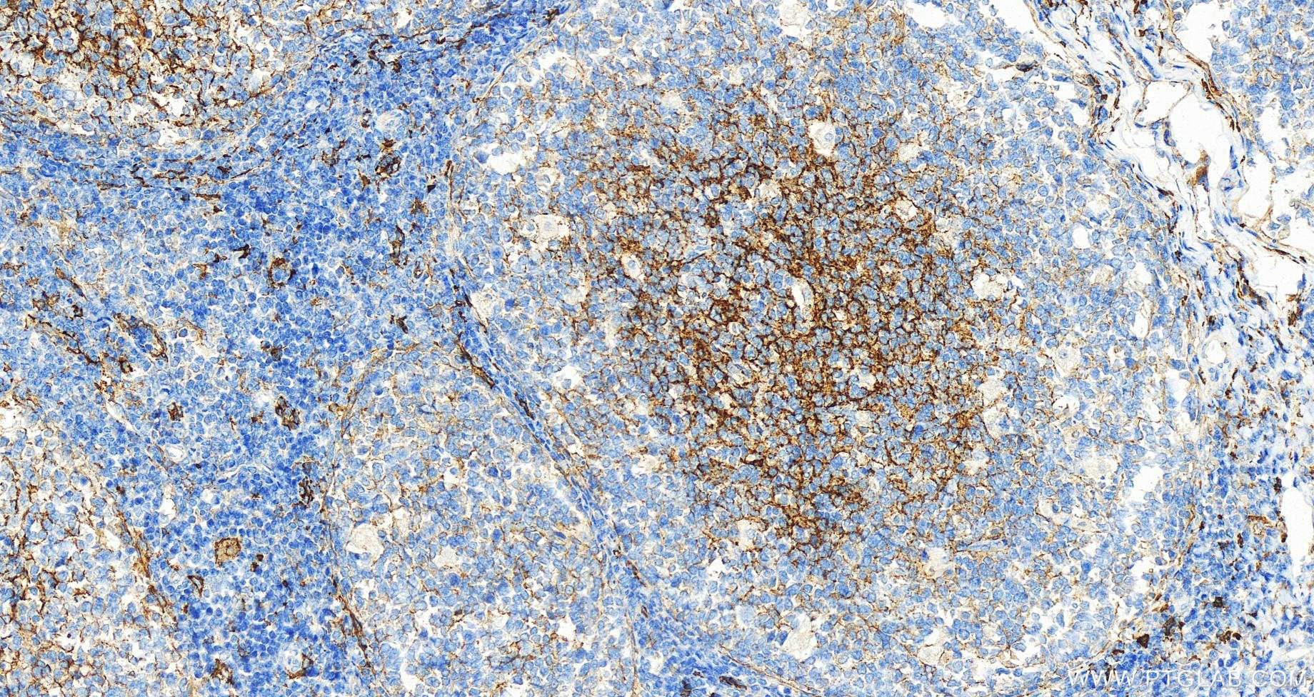 IHC staining of human tonsillitis using 17000-1-AP