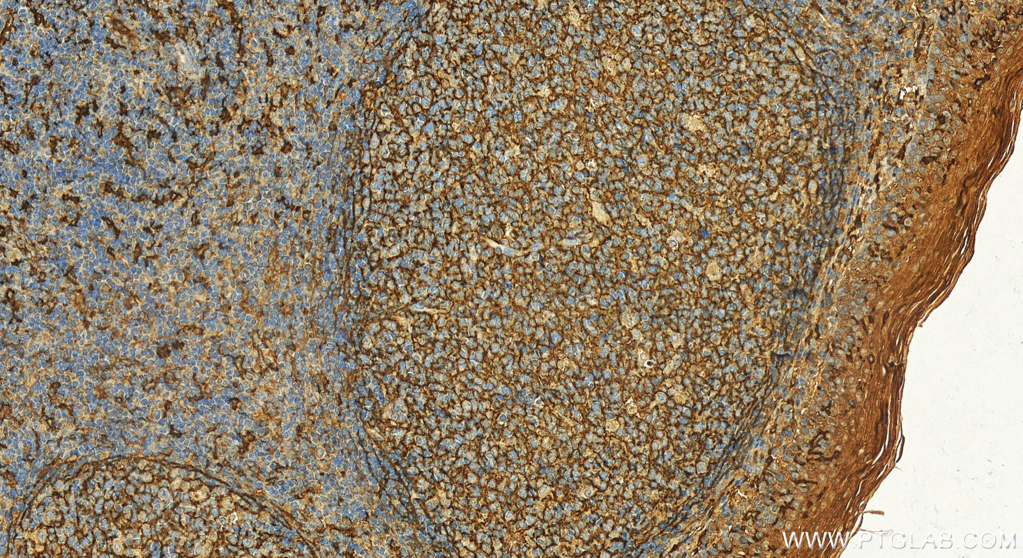 IHC staining of human tonsillitis using 30796-1-AP