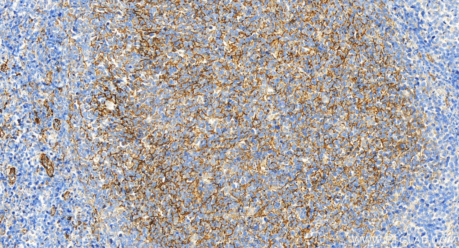 IHC staining of human tonsillitis using 60253-1-Ig