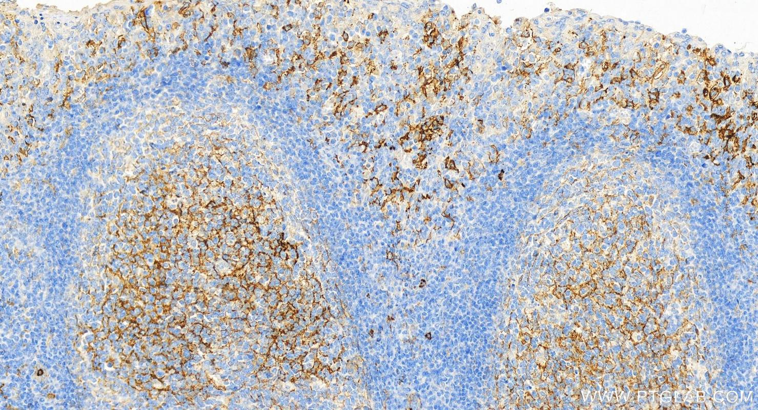 IHC staining of human tonsillitis using 60253-1-Ig