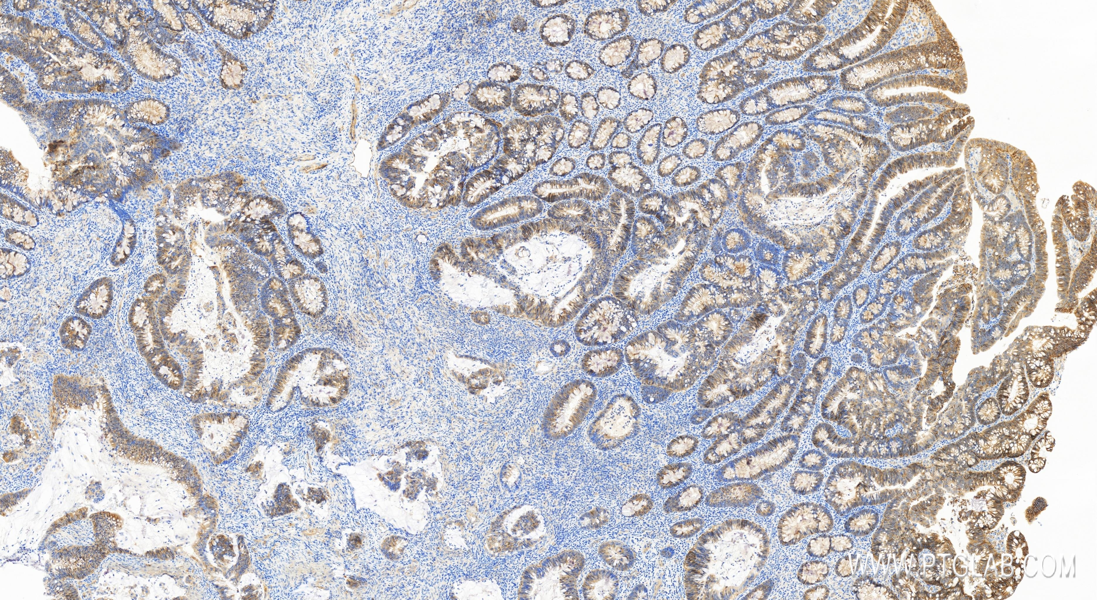 IHC staining of human colon cancer using 84138-5-RR (same clone as 84138-5-PBS)