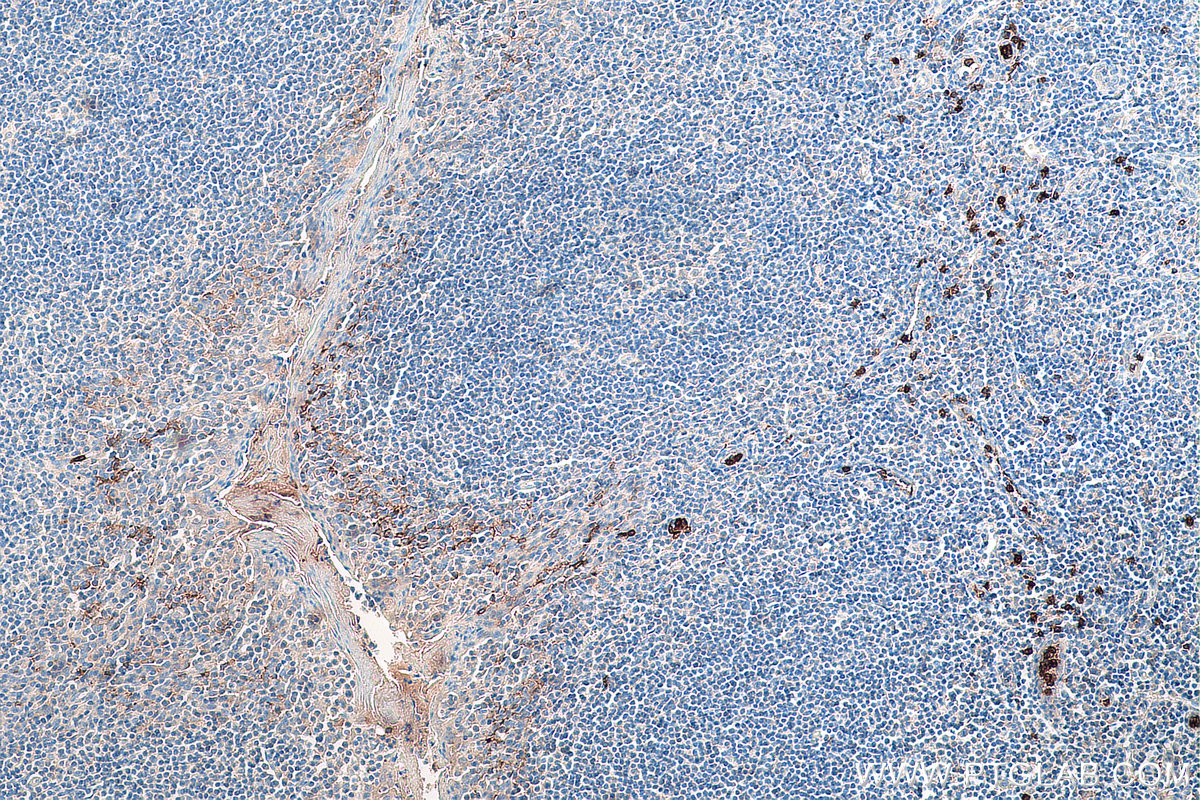 IHC staining of human tonsillitis using 66779-1-Ig