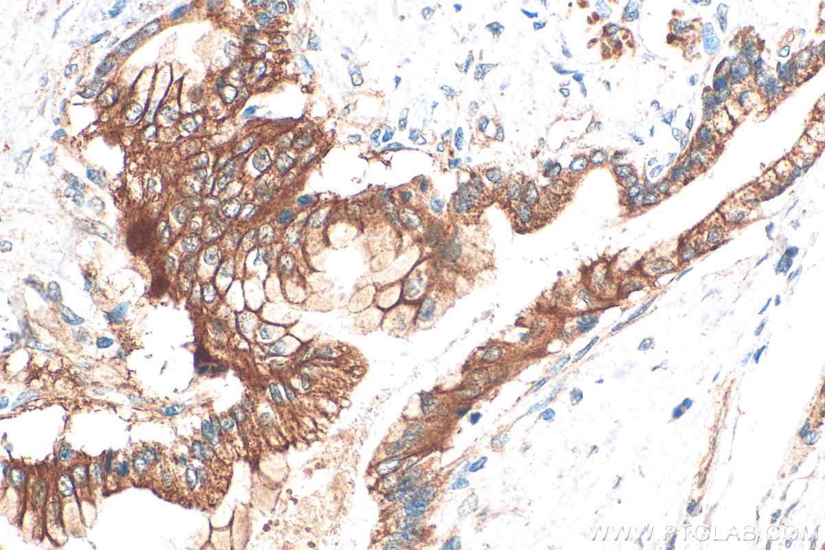 IHC staining of human pancreas cancer using 25488-1-AP