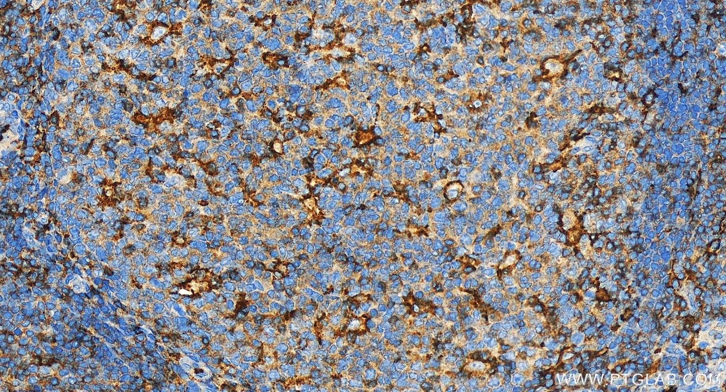 IHC staining of human tonsillitis using 10554-1-AP