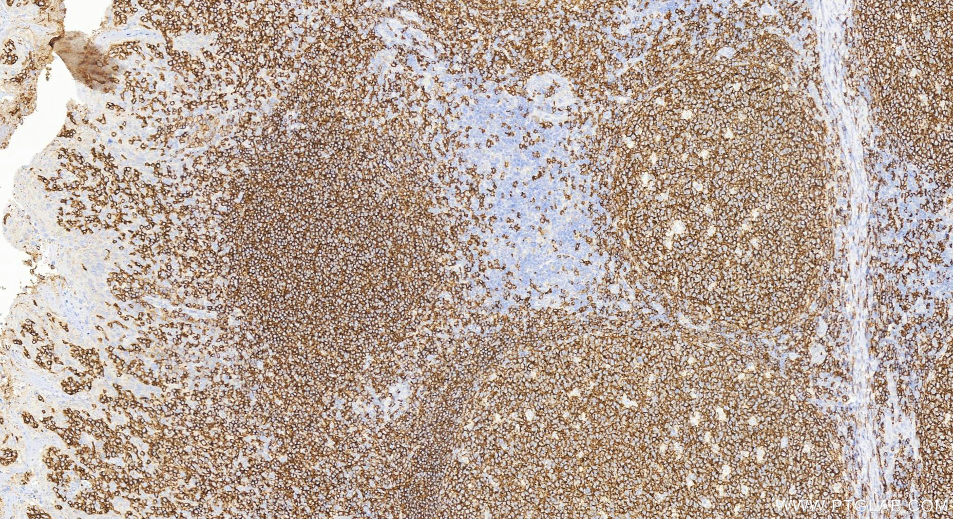 IHC staining of human tonsillitis using 27949-1-AP