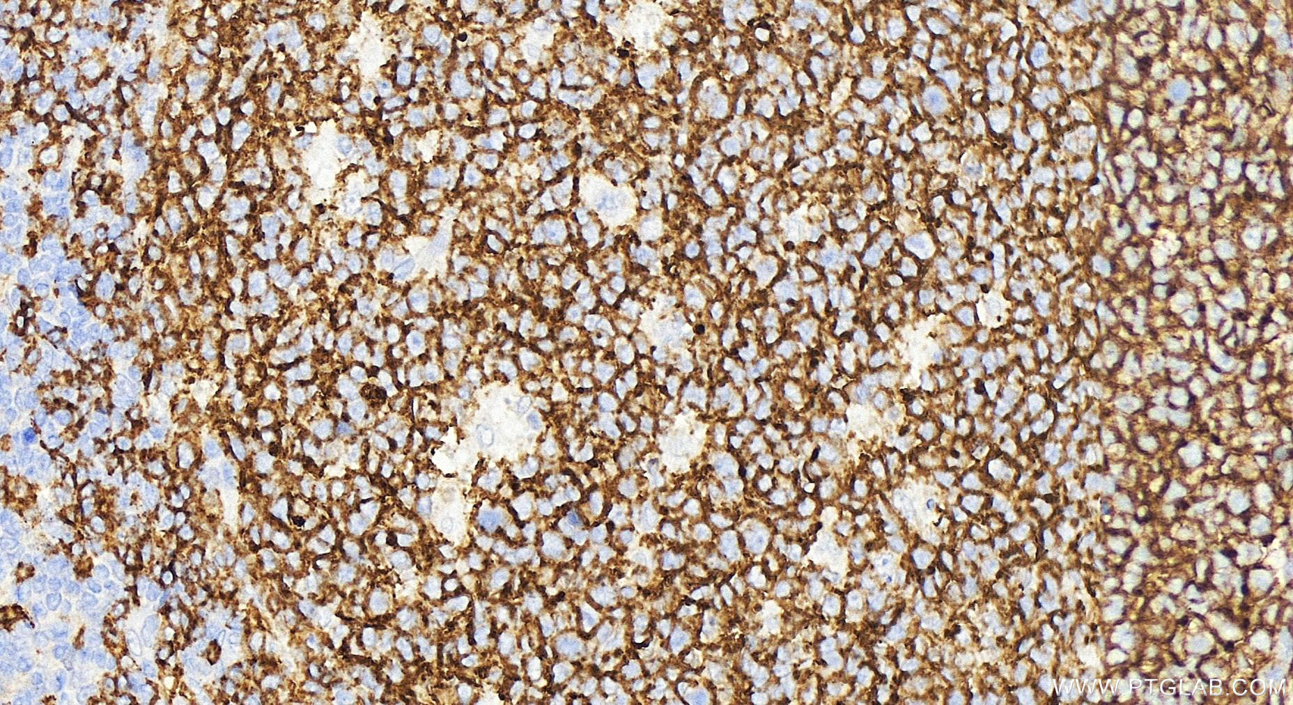 IHC staining of human tonsillitis using 27949-1-AP