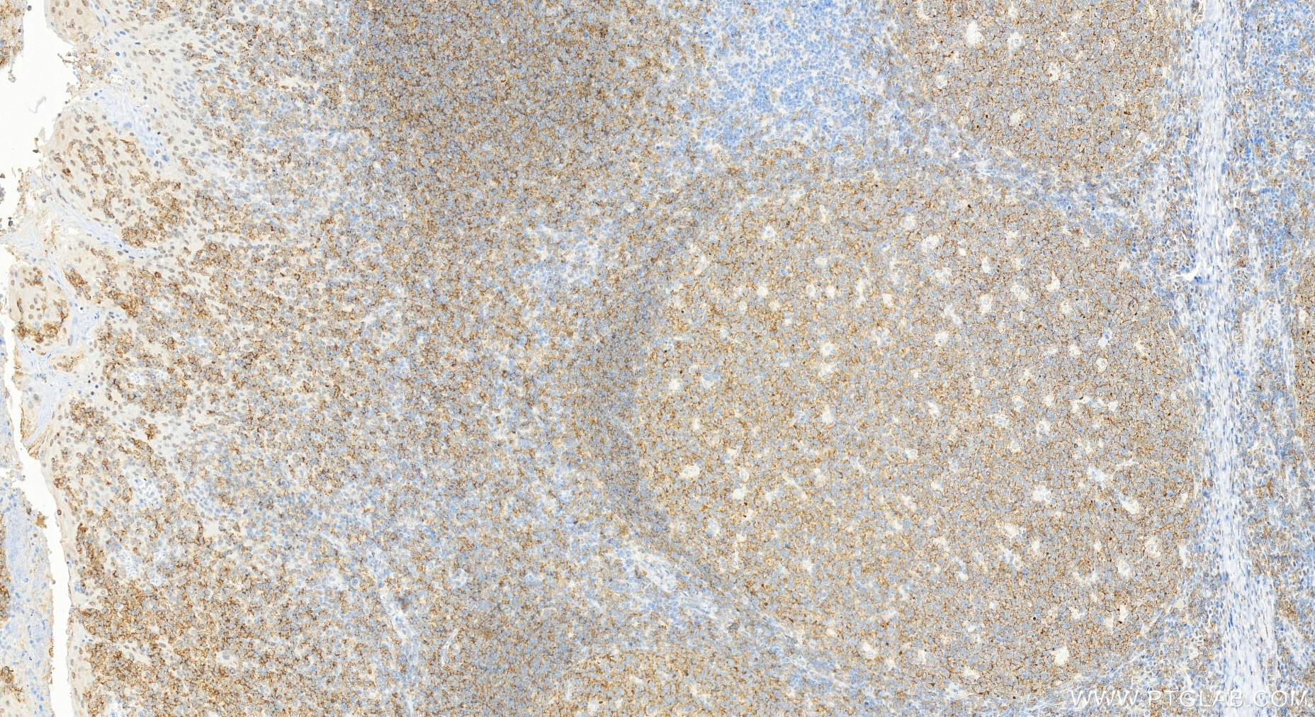 IHC staining of human tonsillitis using 66298-1-Ig (same clone as 66298-1-PBS)