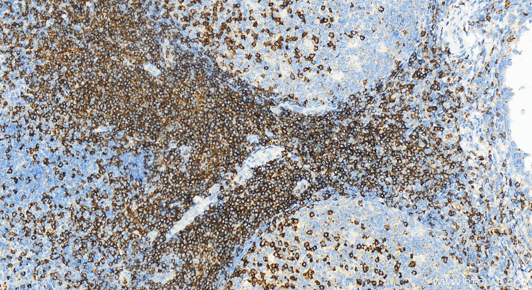 IHC staining of human tonsillitis using 31803-1-AP