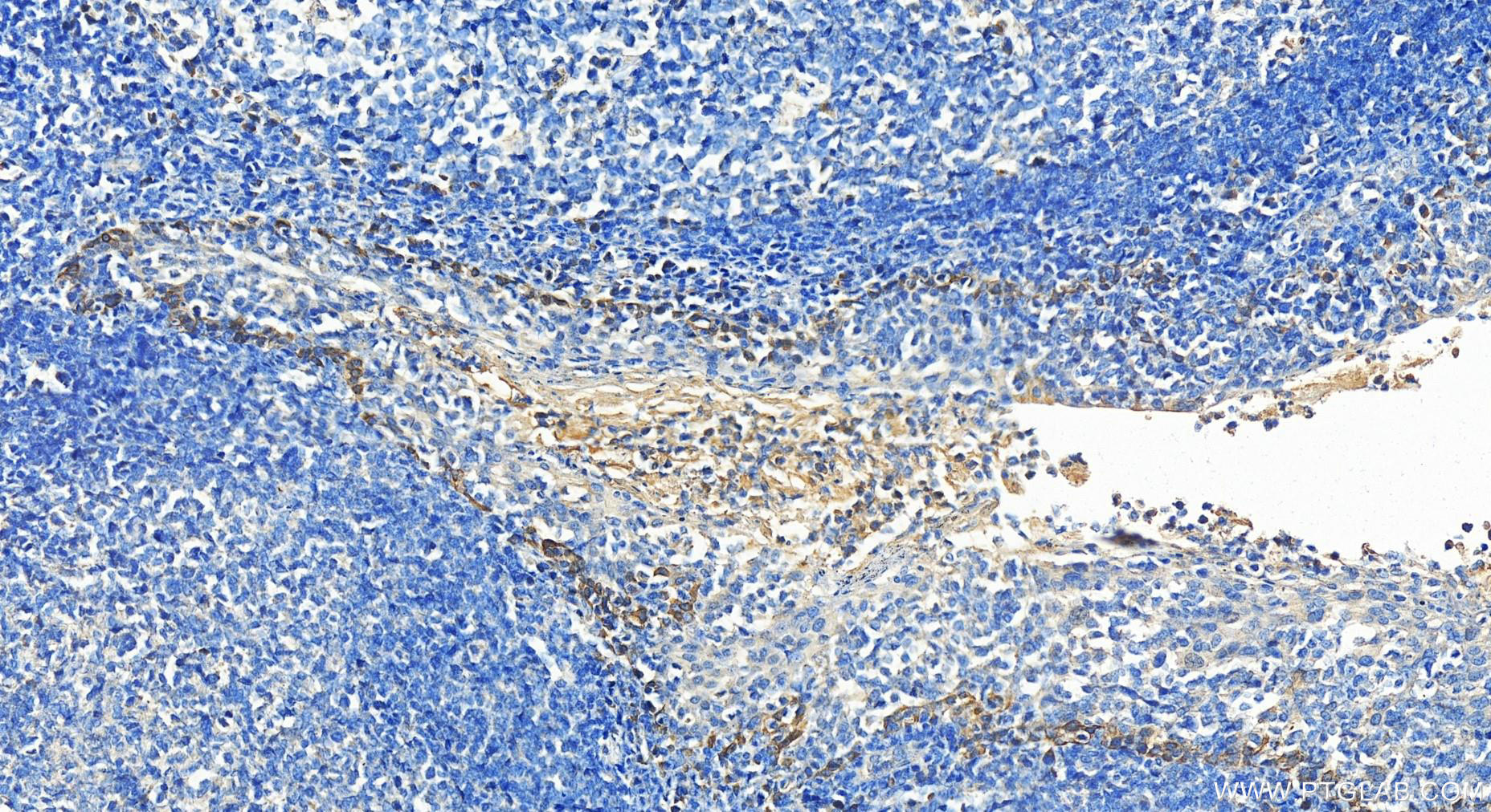 IHC staining of human tonsillitis using 14057-1-AP