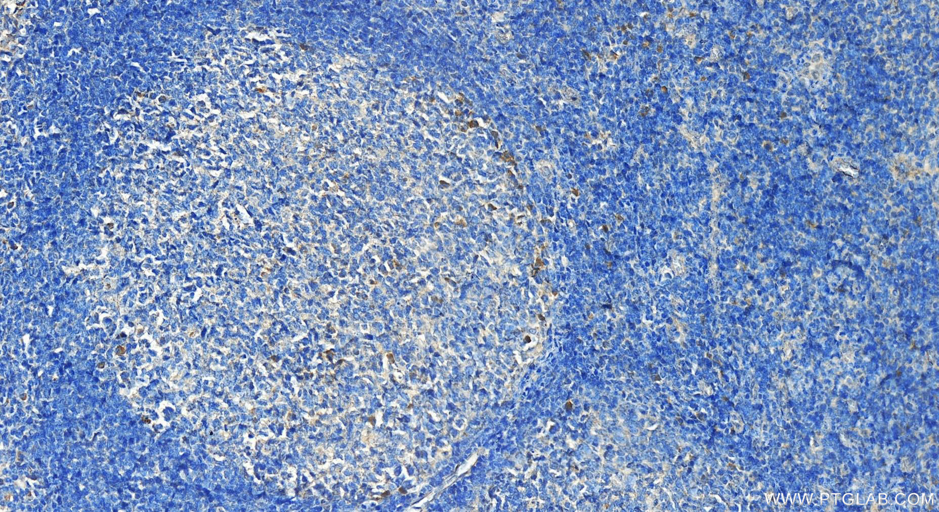 IHC staining of human tonsillitis using 14057-1-AP