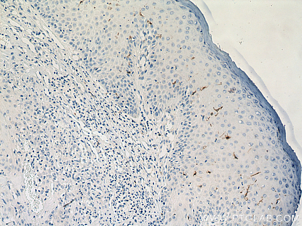 IHC staining of human skin cancer using 11841-1-AP