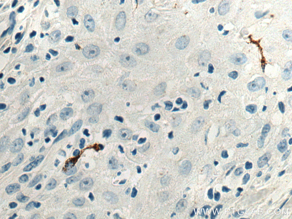 IHC staining of human skin cancer using 67788-1-Ig (same clone as 67788-1-PBS)