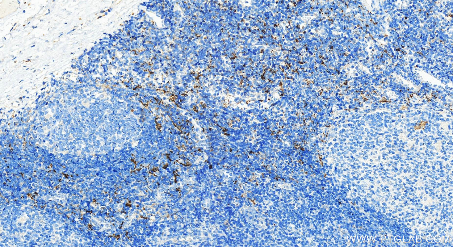 IHC staining of human tonsillitis using 31621-1-AP