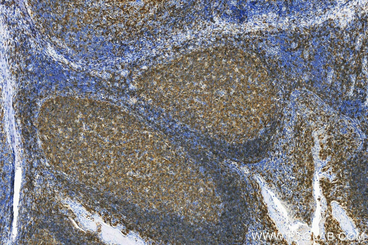 IHC staining of human tonsillitis using 30954-1-AP