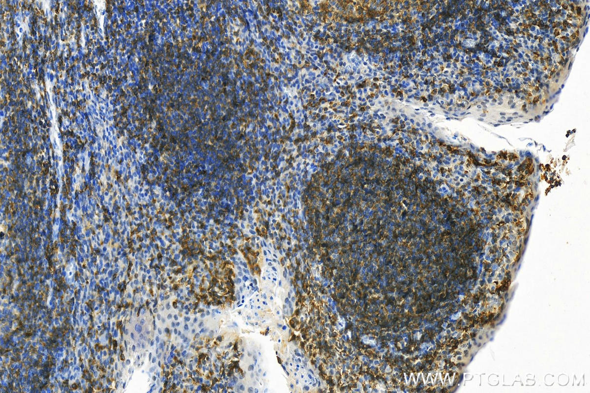 IHC staining of human tonsillitis using 30954-1-AP