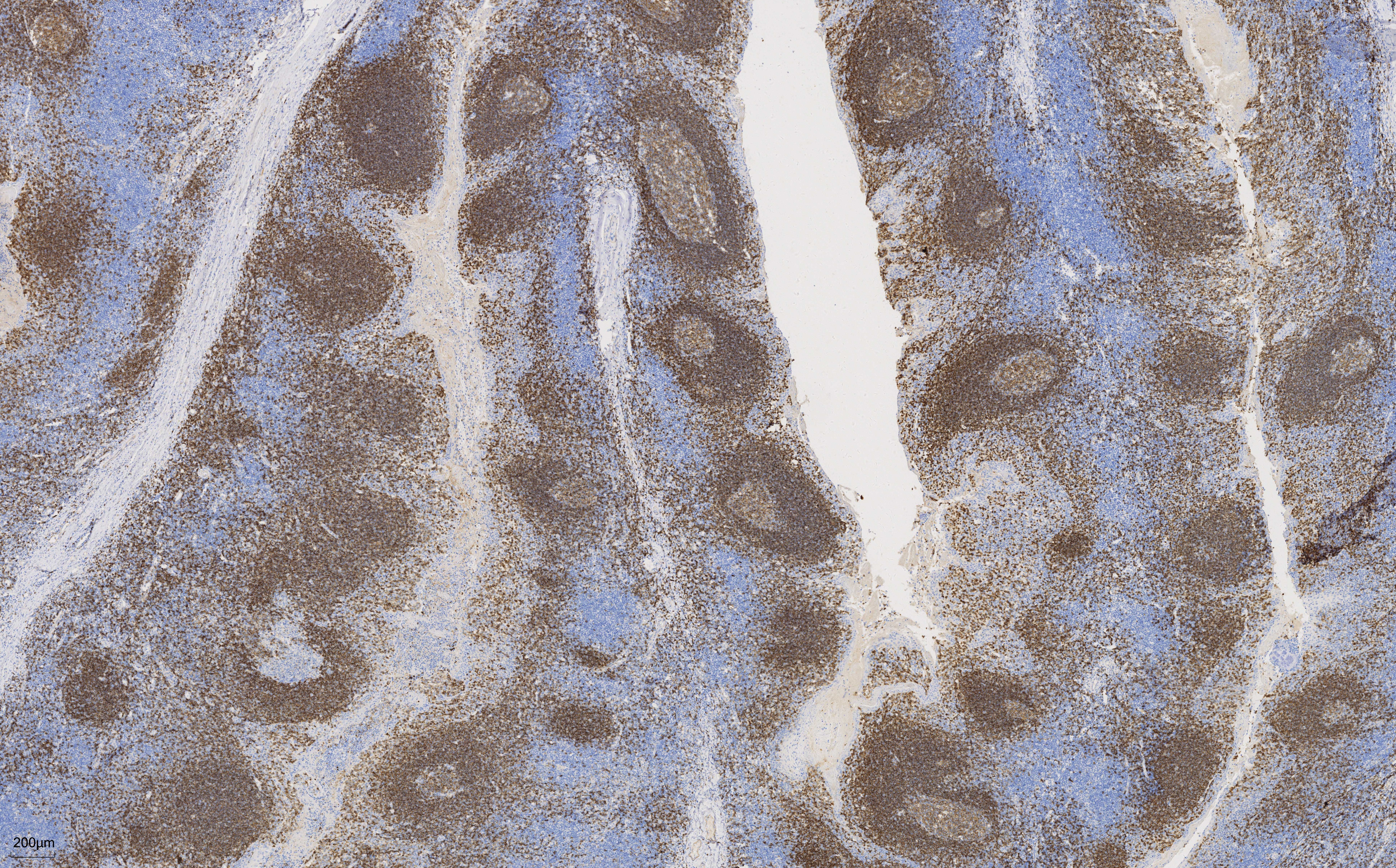 IHC staining of human tonsillitis using 66103-1-Ig