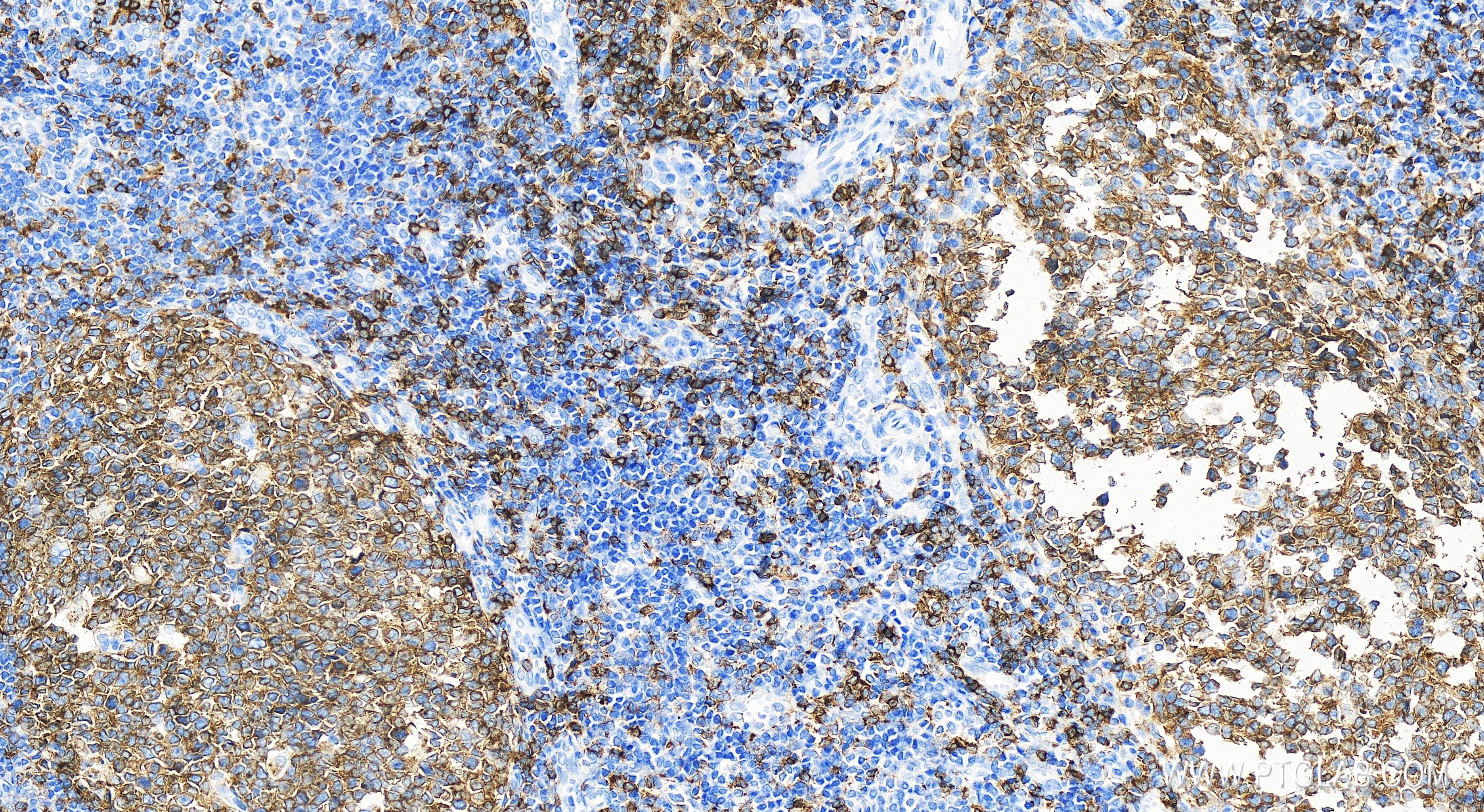 IHC staining of human tonsillitis using 83303-1-RR