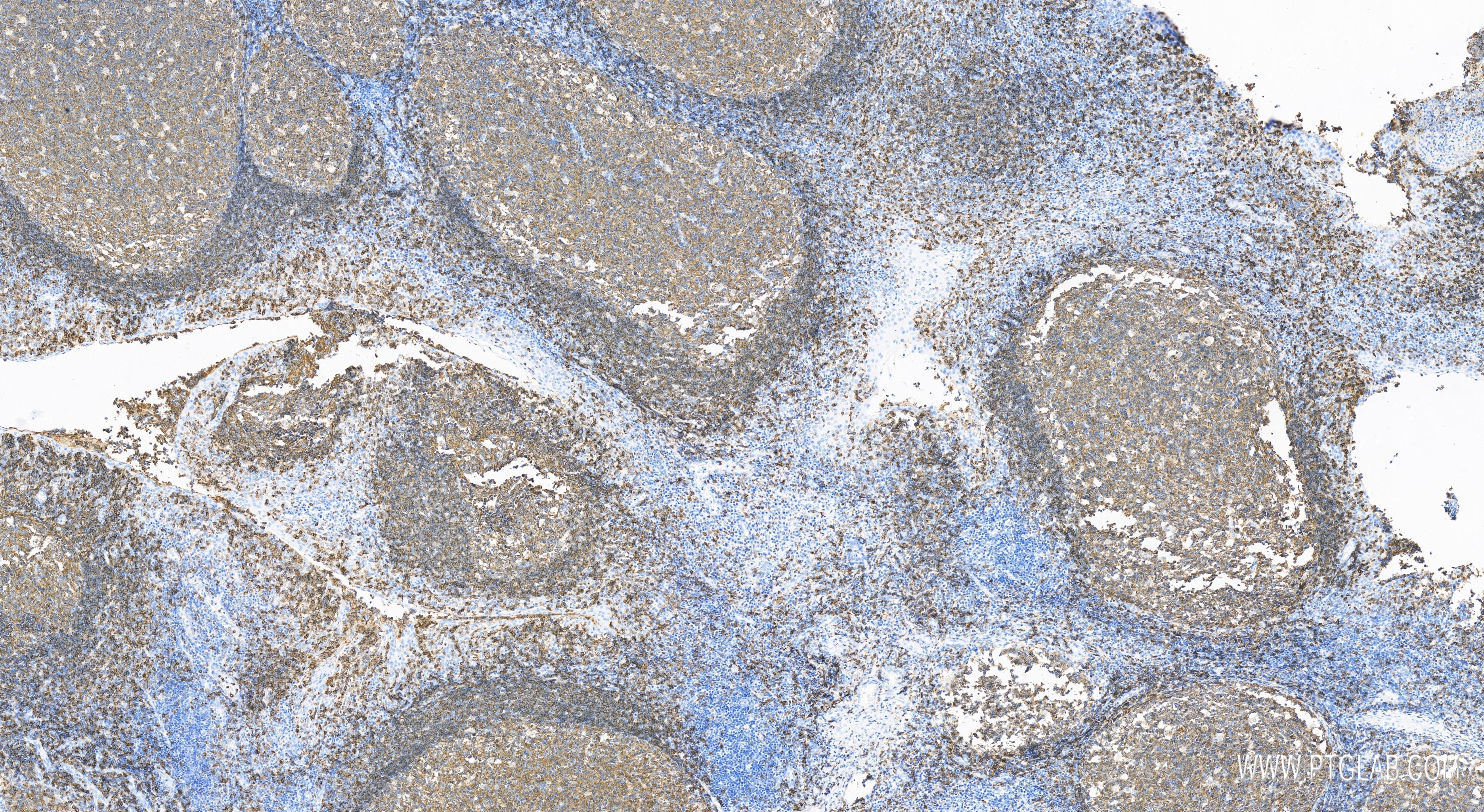 IHC staining of human tonsillitis using 83303-1-RR