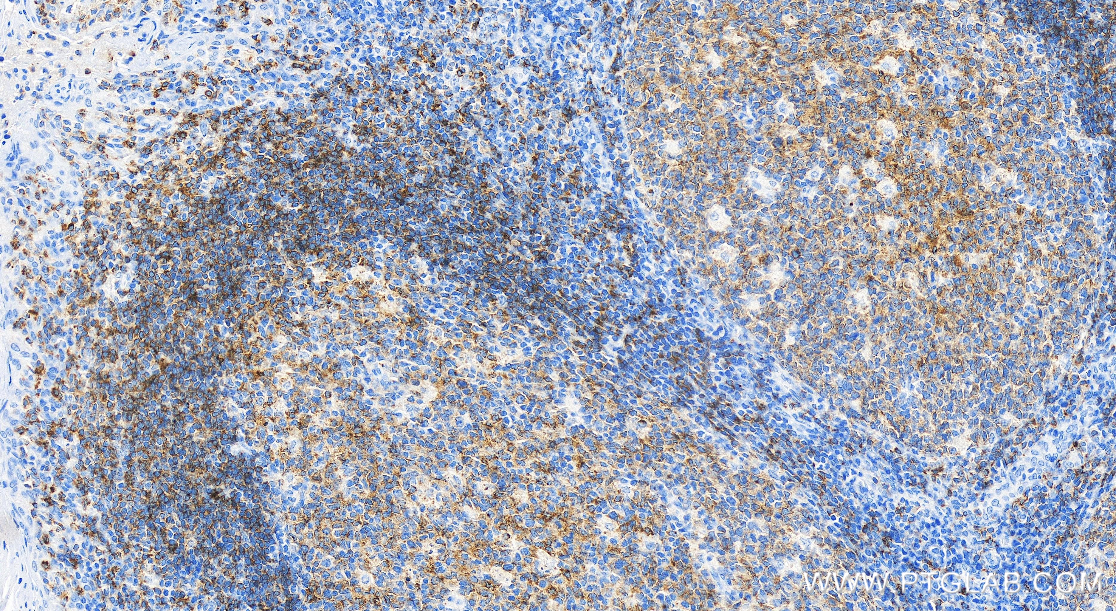 IHC staining of human tonsillitis using 84265-5-RR (same clone as 84265-5-PBS)