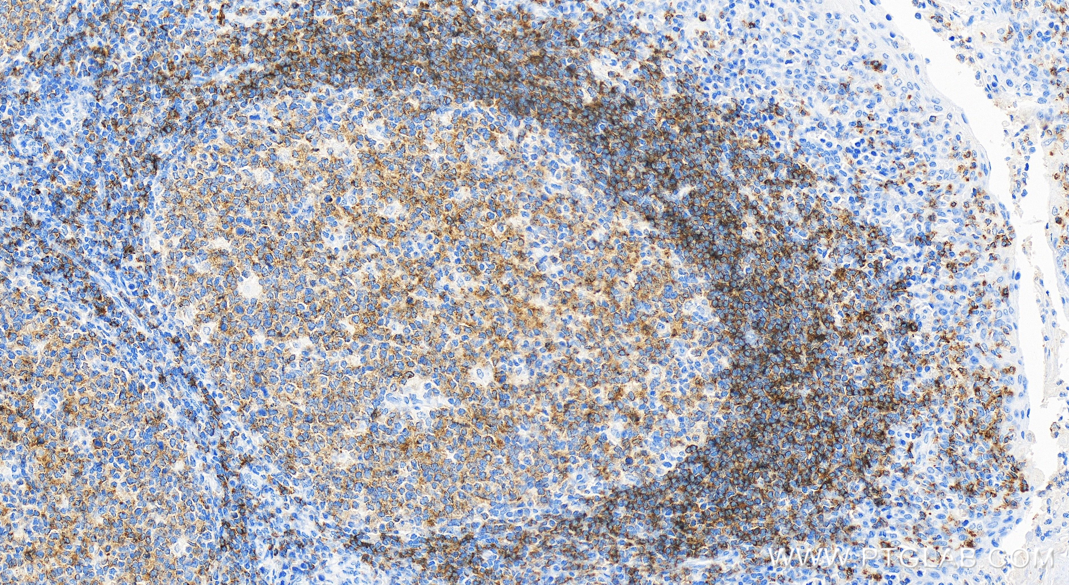 IHC staining of human tonsillitis using 84265-5-RR (same clone as 84265-5-PBS)