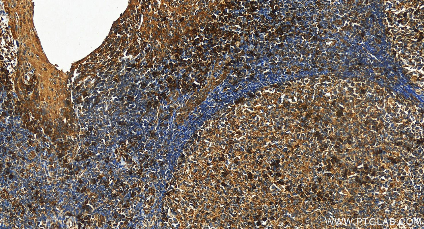 IHC staining of human tonsillitis using 17842-1-AP