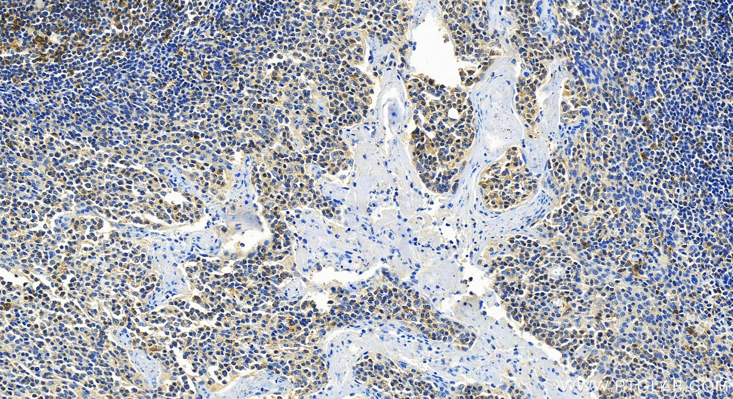 IHC staining of human tonsillitis using 82991-3-RR