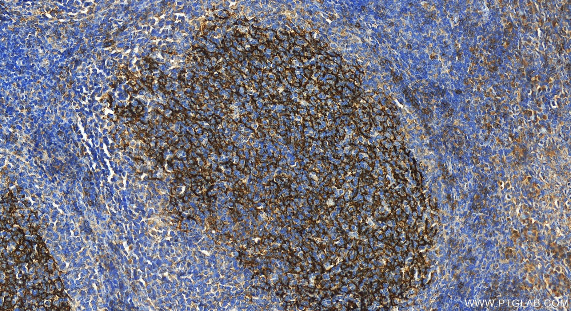 IHC staining of human tonsillitis using 60208-1-Ig (same clone as 60208-1-PBS)