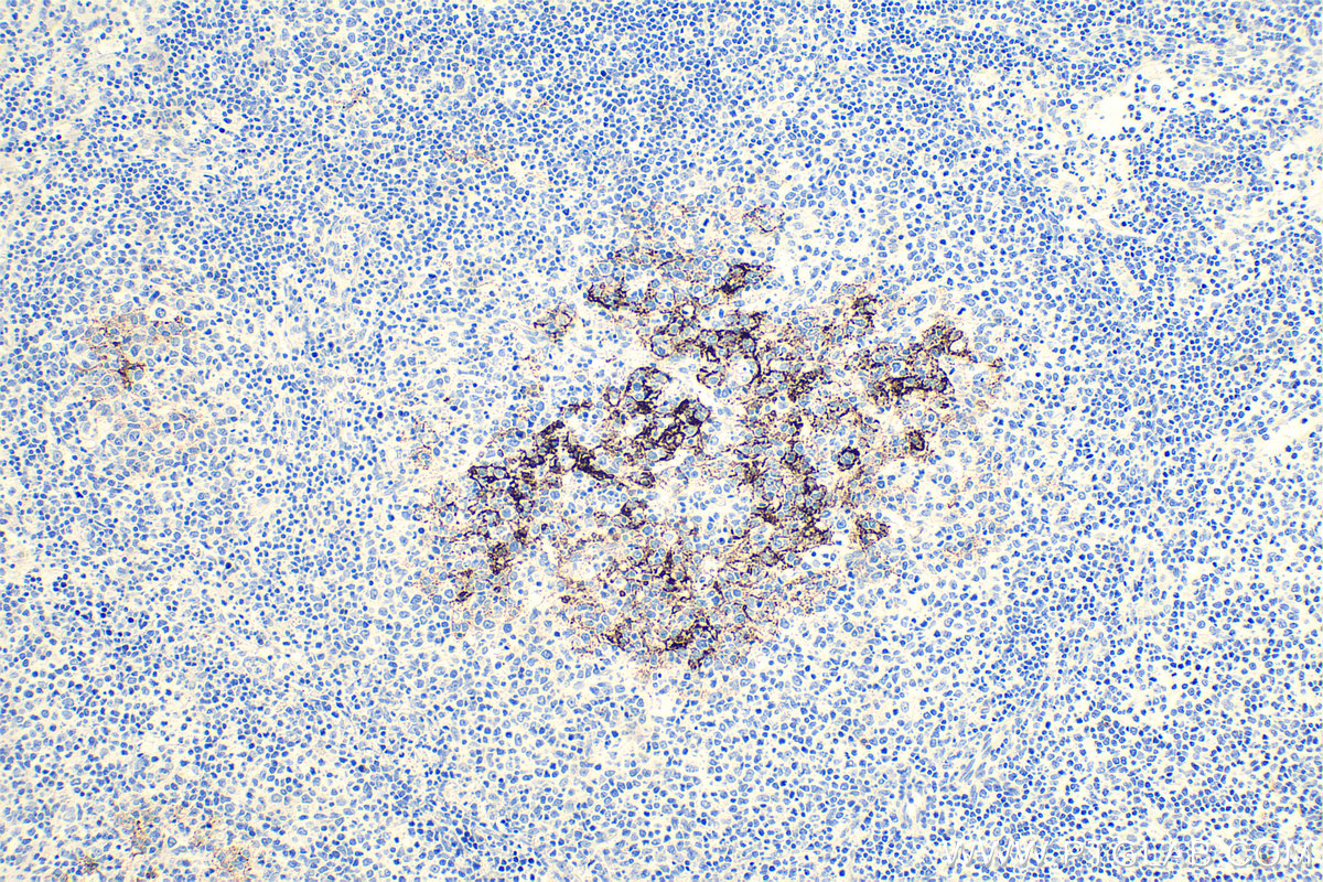 IHC staining of human lymphoma using 60208-2-Ig