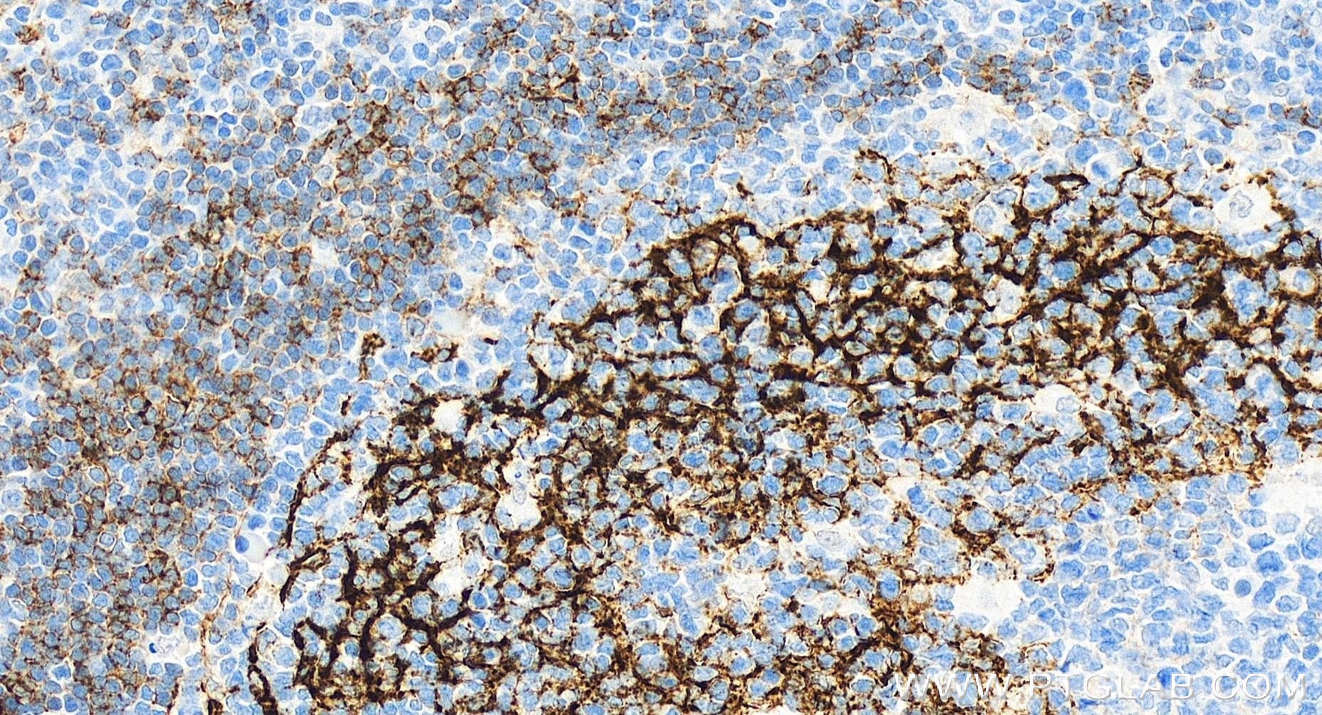 IHC staining of human tonsillitis using 84024-2-RR