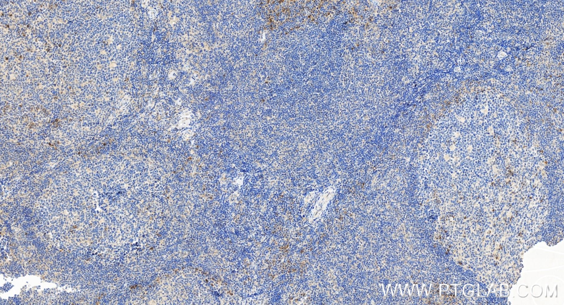 IHC staining of human tonsillitis using 84086-1-RR (same clone as 84086-1-PBS)