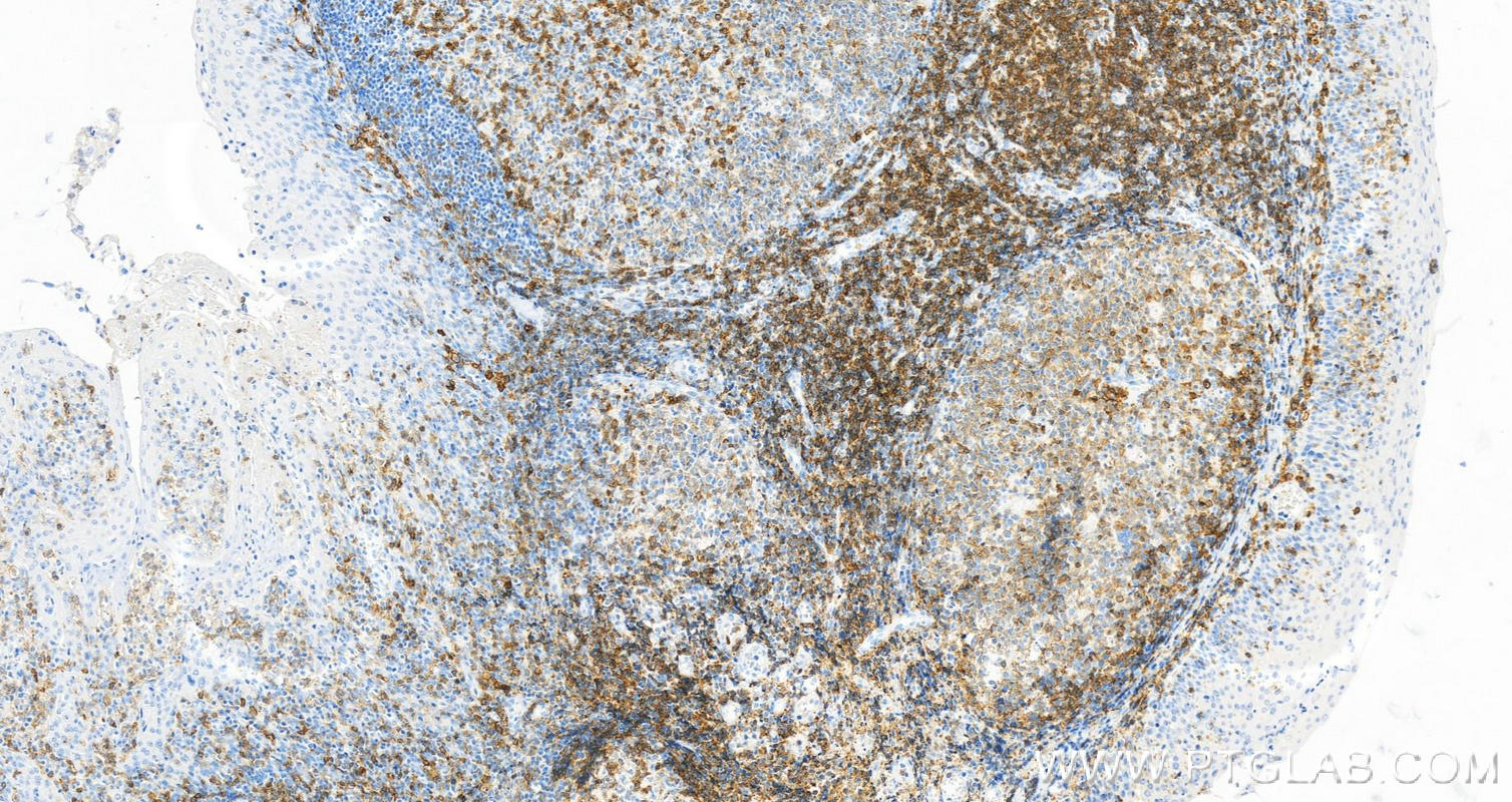 IHC staining of human tonsillitis using 66308-1-Ig (same clone as 66308-1-PBS)