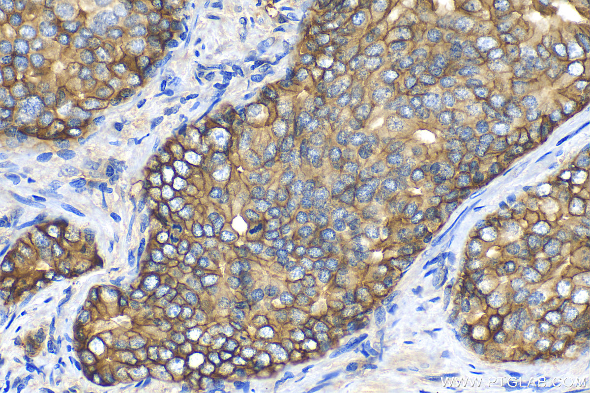 IHC staining of human prostate cancer using 14453-1-AP
