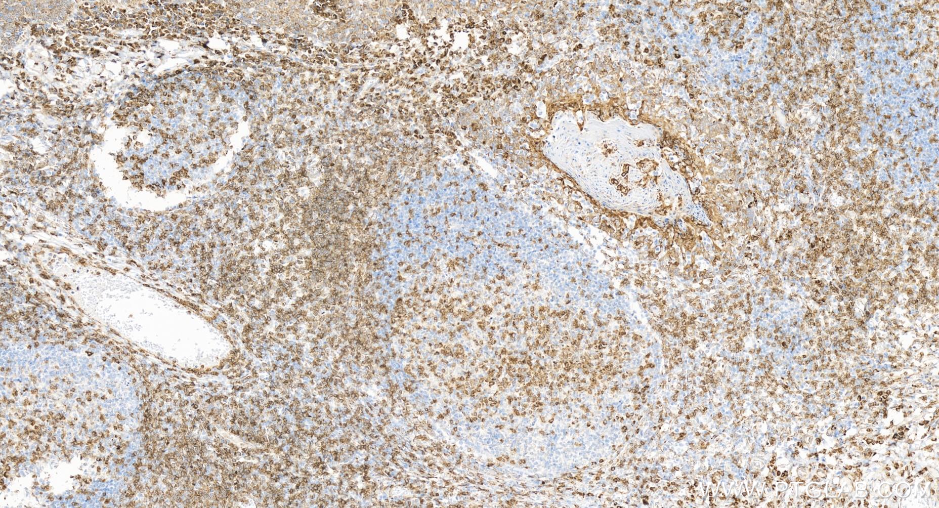 IHC staining of human tonsillitis using 84505-4-RR (same clone as 84505-4-PBS)