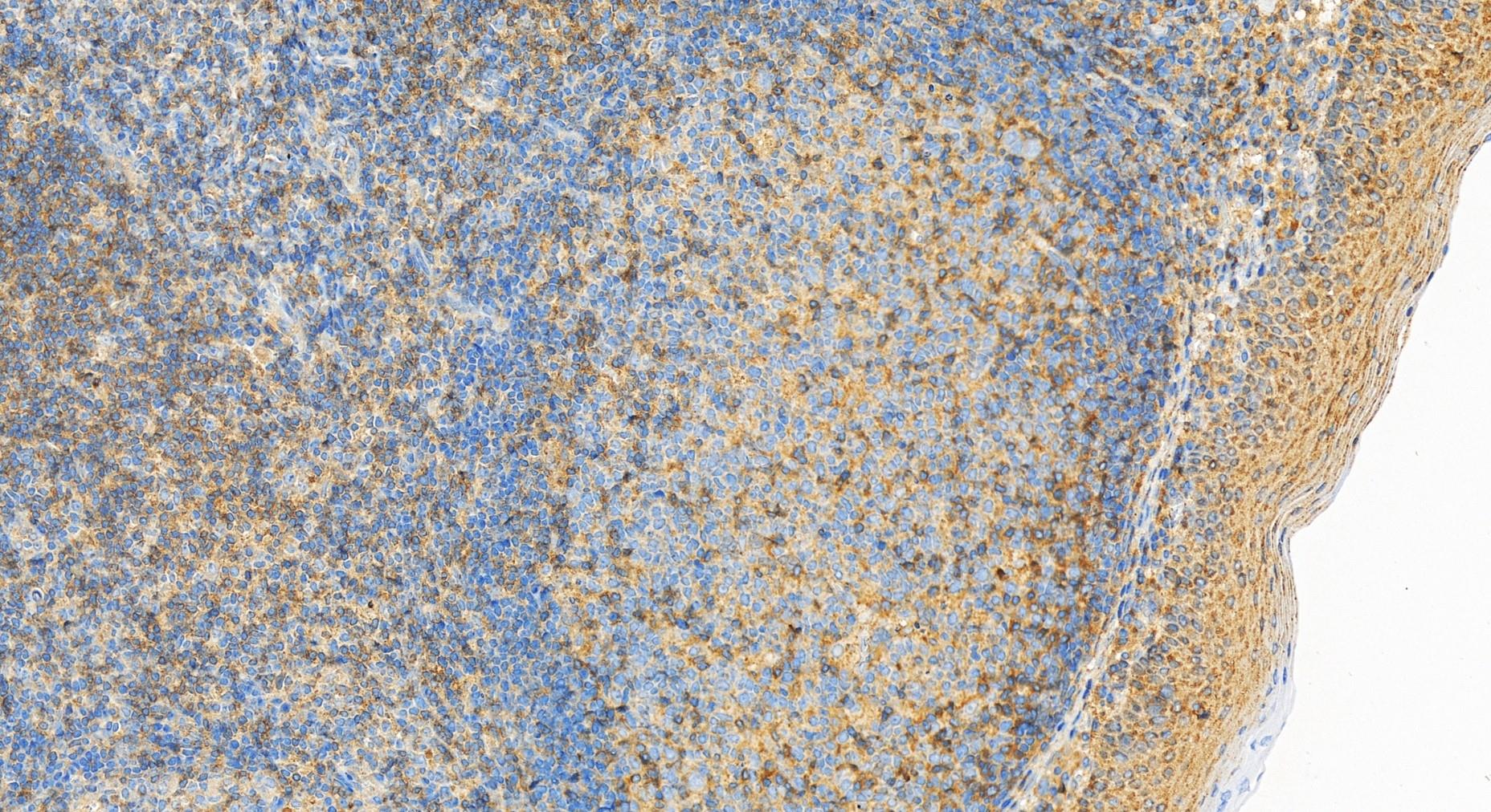 IHC staining of human tonsillitis using 32144-1-AP