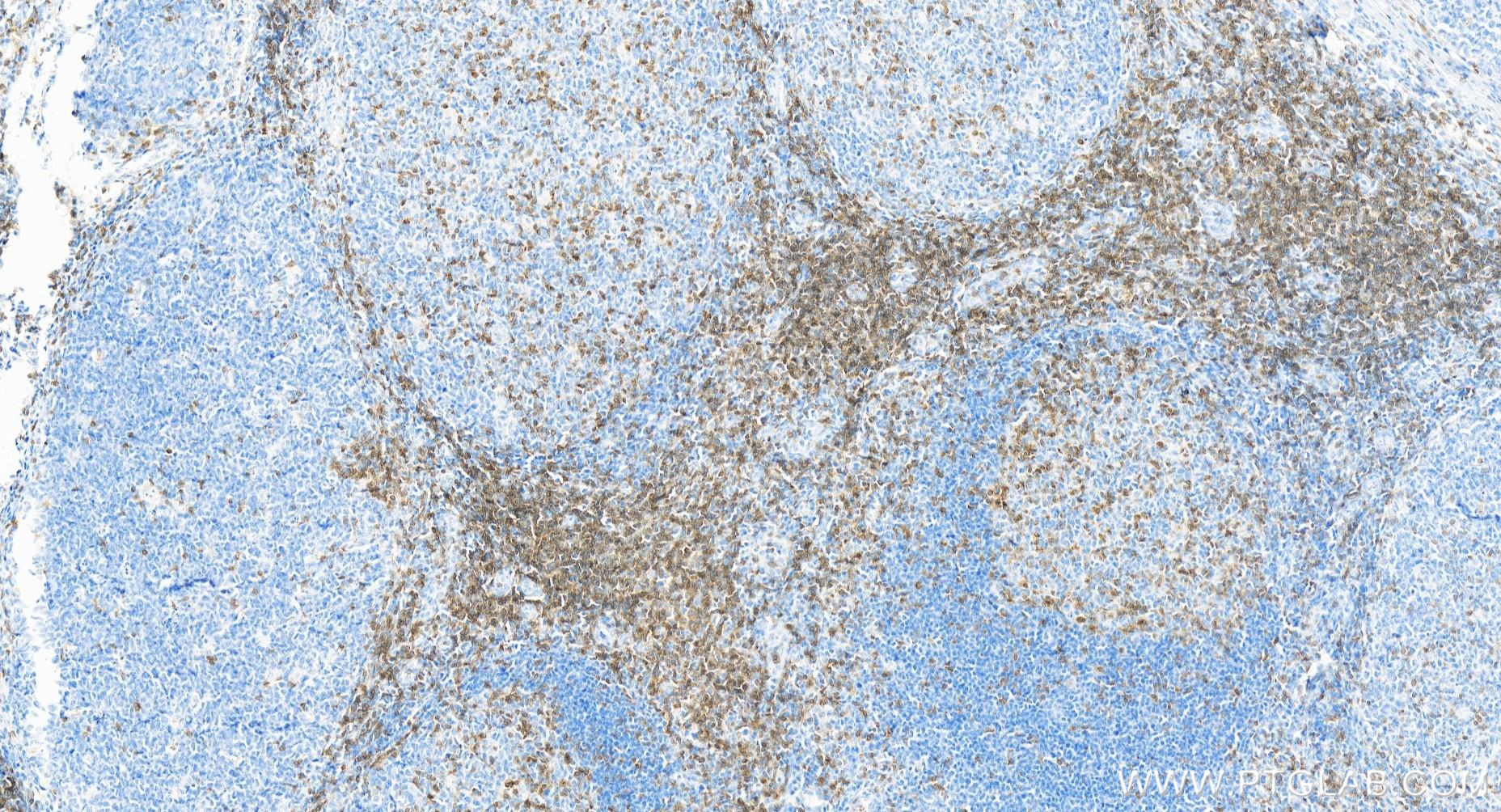 IHC staining of human tonsillitis using 84214-4-RR (same clone as 84214-4-PBS)