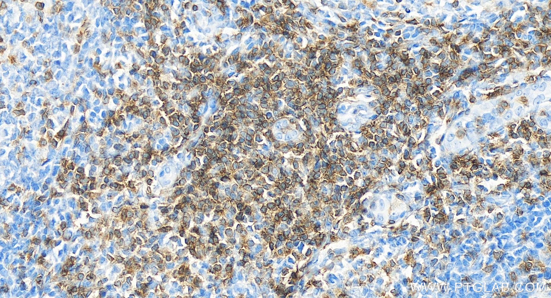 IHC staining of human tonsillitis using 84214-4-RR (same clone as 84214-4-PBS)