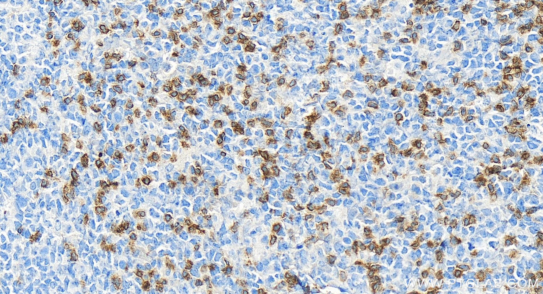 IHC staining of human tonsillitis using 84836-1-RR (same clone as 84836-1-PBS)