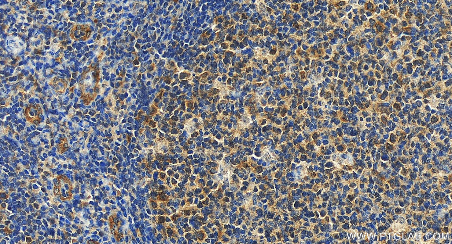 IHC staining of human tonsillitis using 24145-1-AP