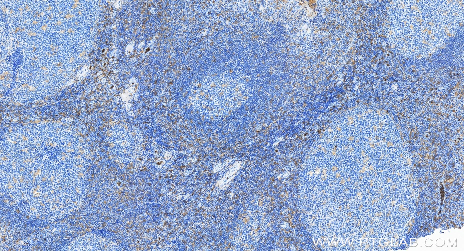 IHC staining of human tonsillitis using 84341-3-RR (same clone as 84341-3-PBS)